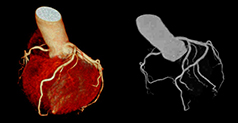 CT心臓3D／CT心臓MIP