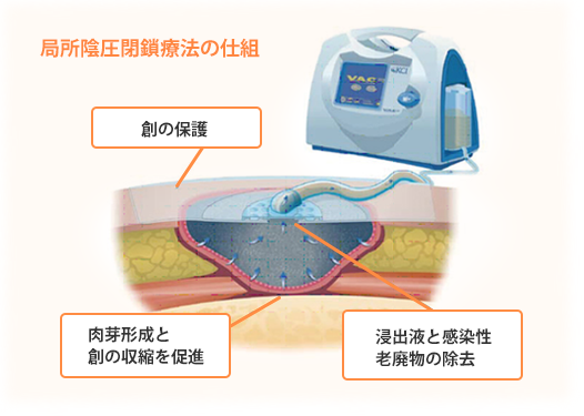 局所陰圧閉鎖療法の仕組